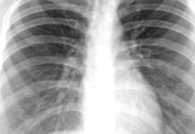 Creyó que tenía tuberculosis, pero era un preservativo en el pulmón