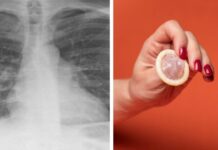 Maestra fue al hospital para atenderse de tuberculosis y le encontraron un preservativo en los pulmones